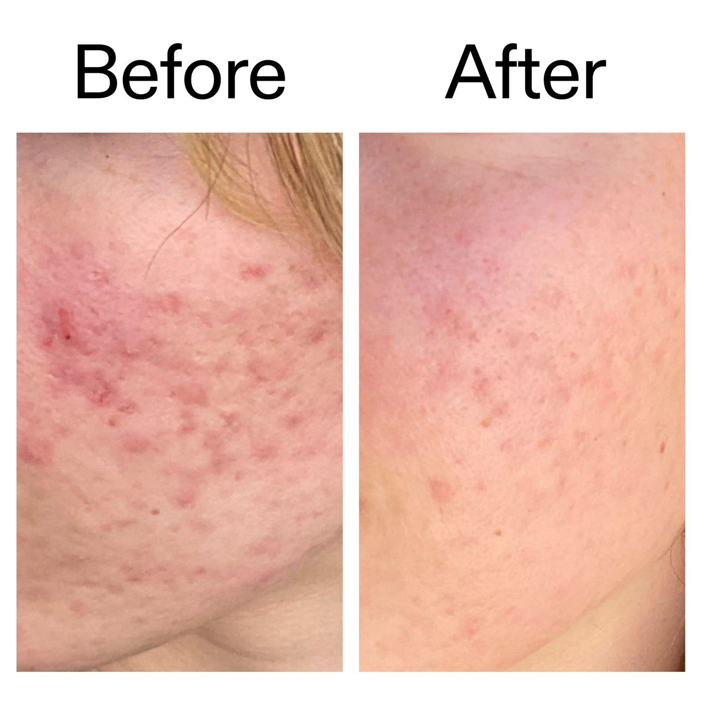 10-azelaic-acid-serum-for-redness-relief-p0 Azealic_Acid_Serum_B_A_Ppage_2000_x_2000.jpg