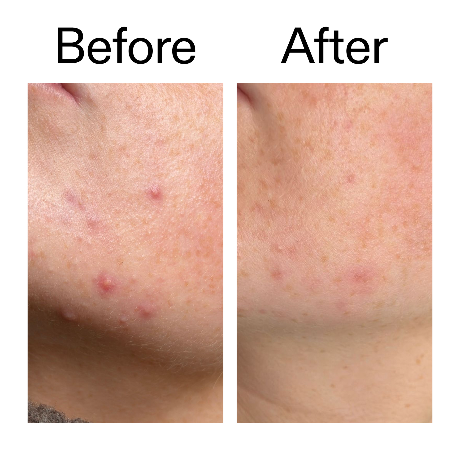 10-azelaic-acid-serum-for-redness-relief-p0 B_A_1_PPAGE.png