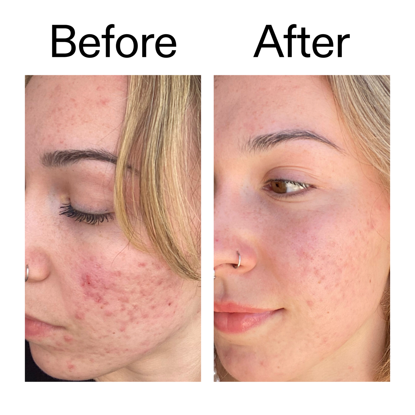 10-azelaic-acid-serum-for-redness-relief-p0 B_A_2_PPAGE.png