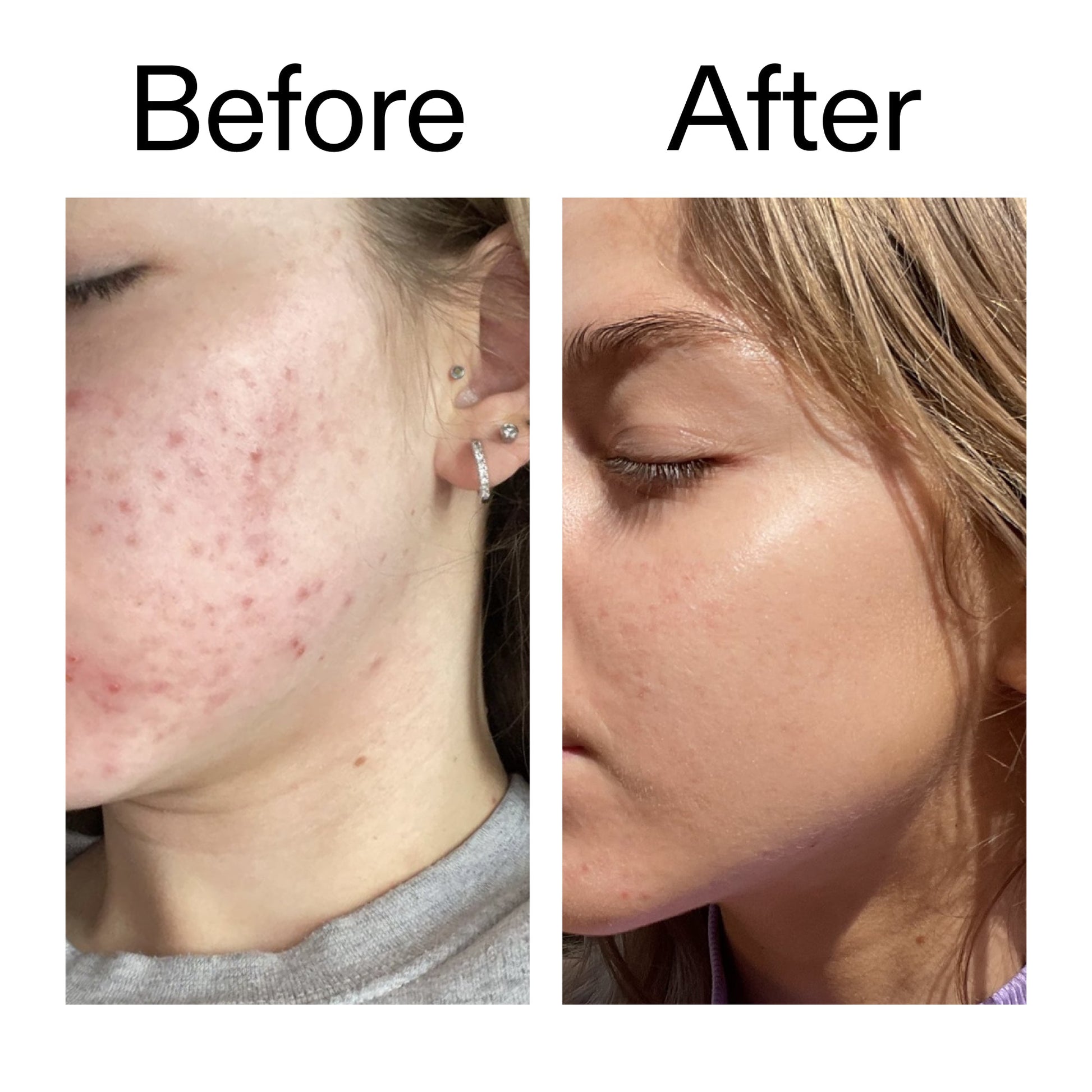 beta-hydroxy-acid-bha-serum-c7 Beta_Hydroxy_Acid_Serum_Before_After_2000x2000_96fda3e5-938d-49ef-bcf2-a0fa6ece4e2c.jpg