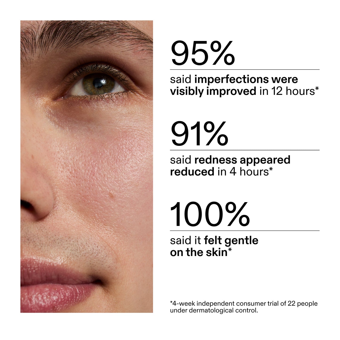 succinic-acid-acne-treatment-g8 CA_Succinic_Acid_Treatment_key_Claims_2000x2000_db91b0f1-7f29-4bfe-bb16-63a47f500960.jpg