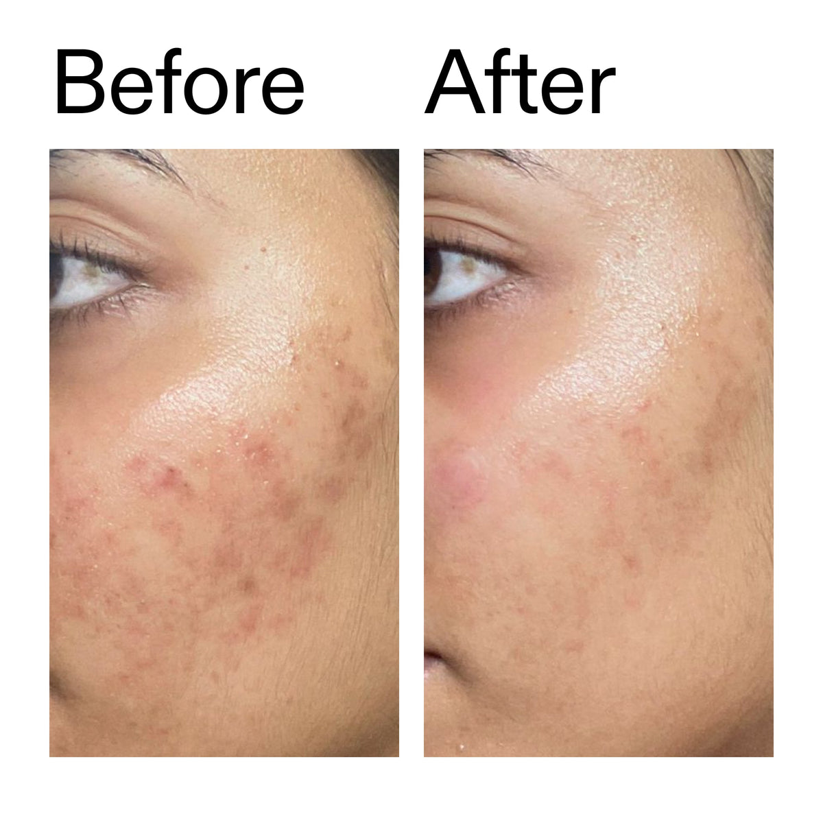 ectoin-hydro-barrier-serum-v4 Ectoin_Hydro-barrier_Serum__Before_After_2000x2000_34261920-d004-48d0-9c7b-8e1c15971bfd.jpg