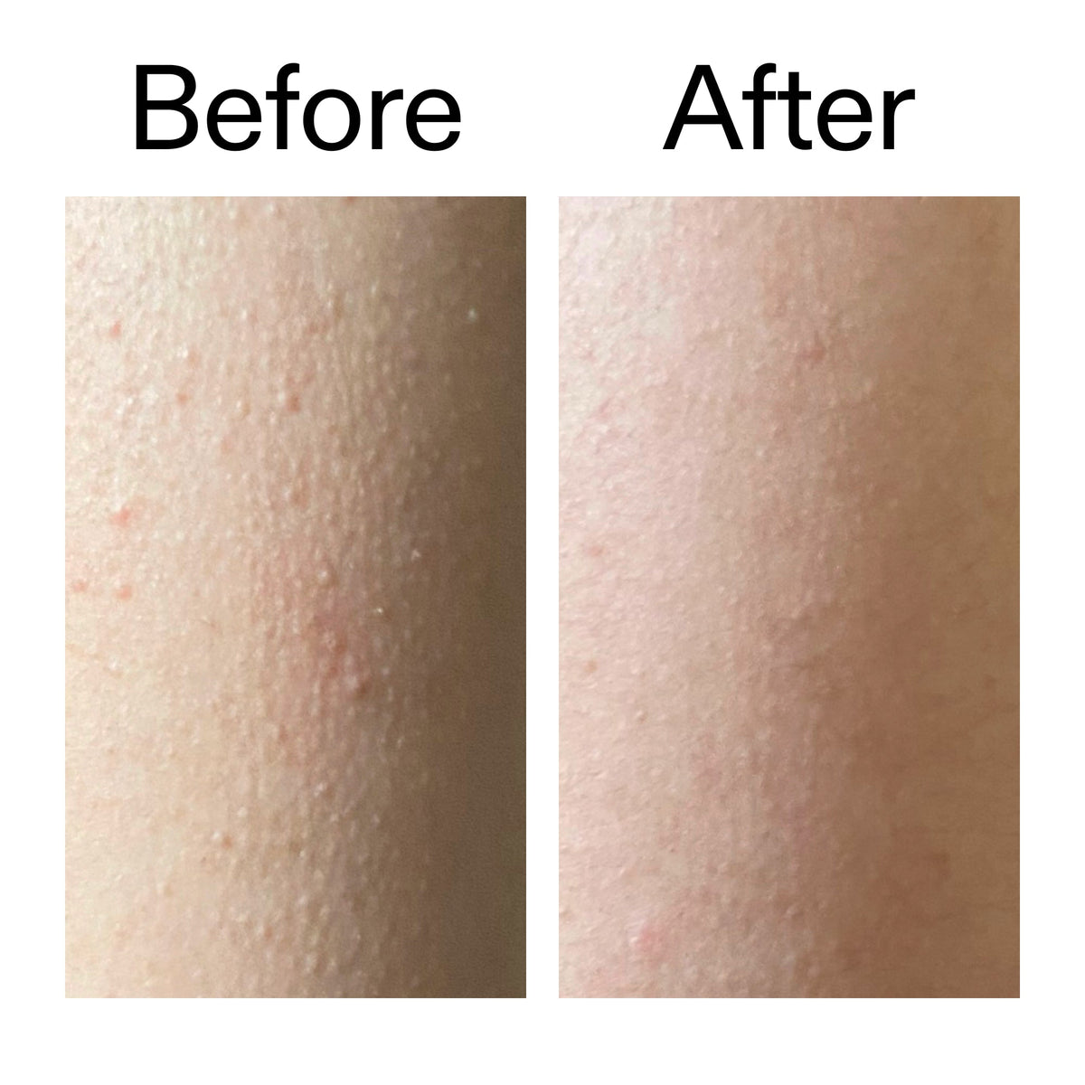 glycolic-acid-exfoliating-body-stick-duo-y3 Glycolic_Acid_Exfoliating_Body_Stick_Before_After_V2_2000x2000_2e4ba052-94f6-4d56-82df-7bdb5b2df7ae.jpg