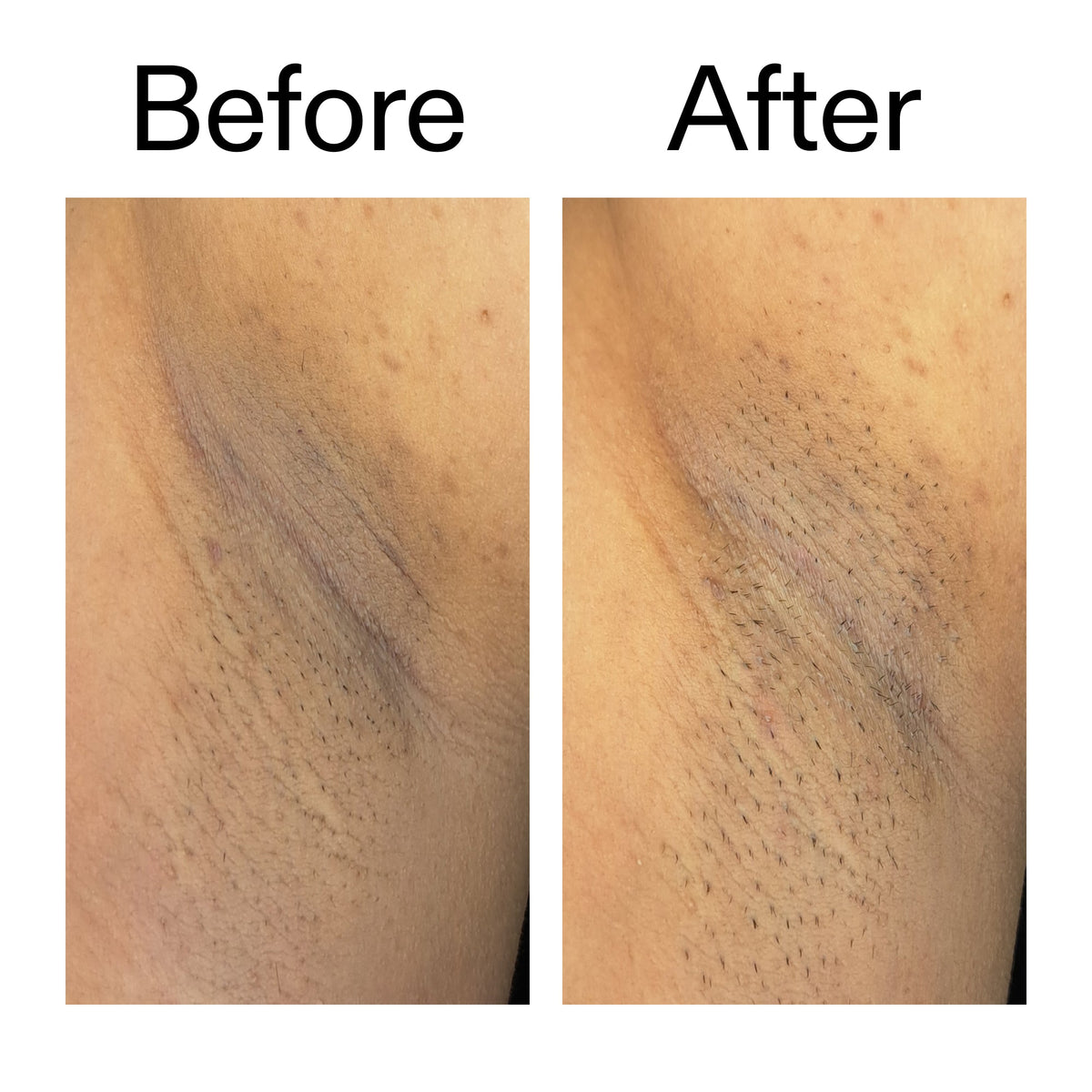 glycolic-acid-exfoliating-body-stick-duo-y3 Glycolic_Acid_Exfoliating_Body_Stick_Before_After_V3_2000x2000_ea919cd9-1439-4a46-82a0-76200eb5bb42.jpg