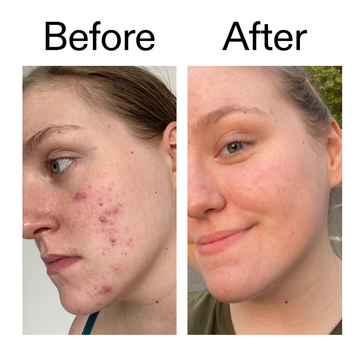 glycolic-acid-toner-l1 Glycolic_Acid_Toner_Before_After_2000x2000_49f0b9f7-e71b-4b2e-a8f8-2ea4b73247bb.jpg