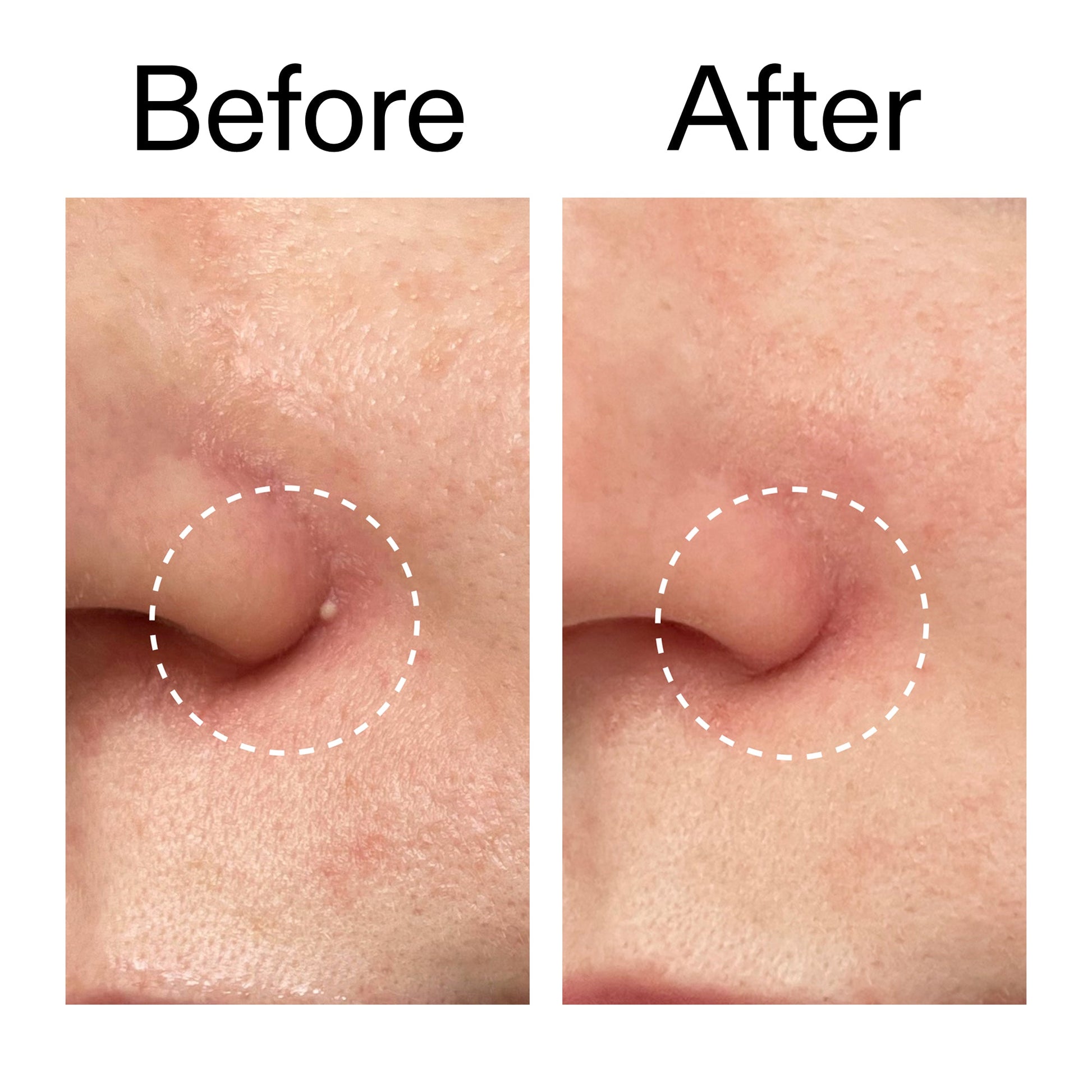hydrocolloid-invisible-pimple-patches-pack-of-22-e2 Hydrocolloid_Invisible_Pimple_Patches_Before_After_2000x2000_b02aa37b-c78a-4682-91de-9135af5bb7df.jpg