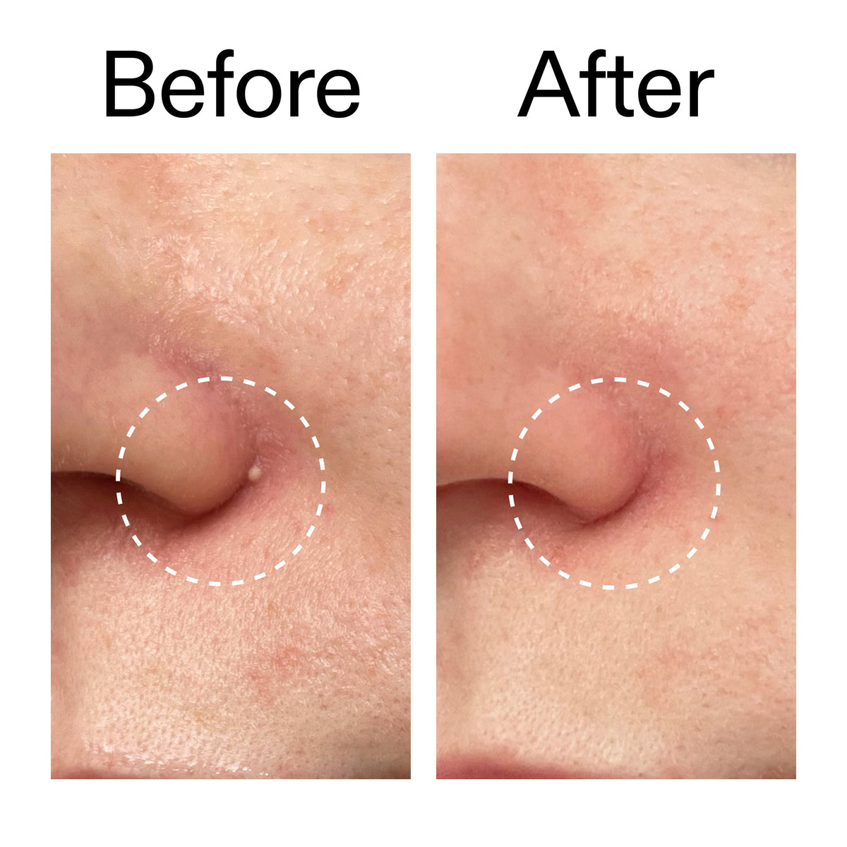 hydrocolloid-invisible-pimple-patches-pack-of-44-a1 Hydrocolloid_Invisible_Pimple_Patches_Before_After_2000x2000_b02aa37b-c78a-4682-91de-9135af5bb7df.jpg