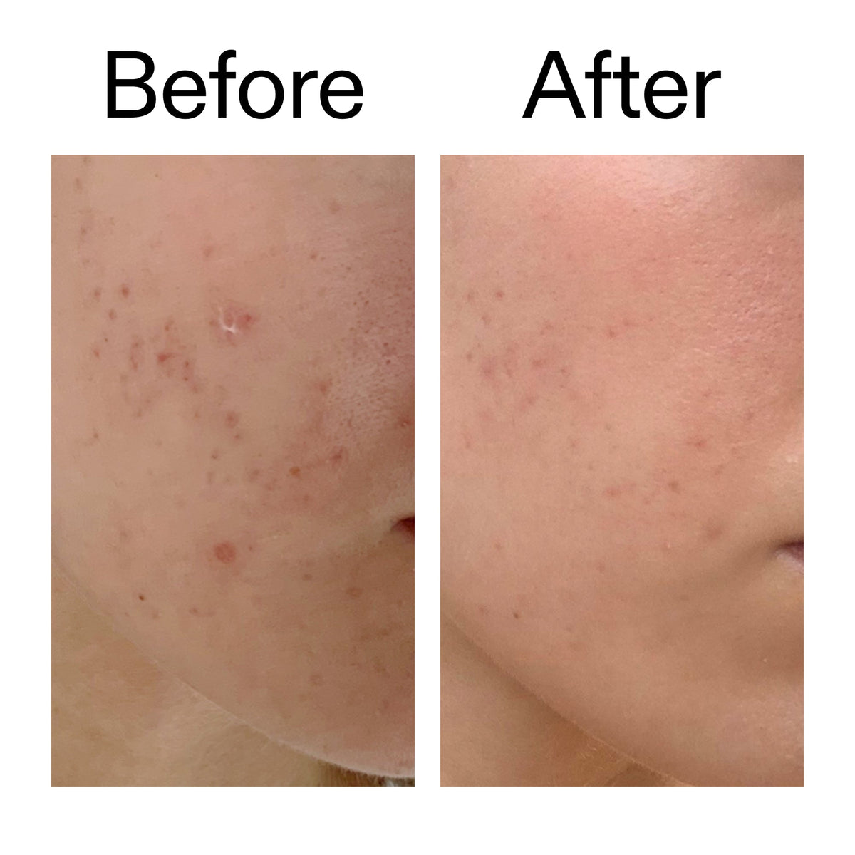 mandelic-acid-treatment-t0 Mandelic_Acid_Treatment_Before_After_2000x2000_4885ac6e-c5d7-4279-a72a-1417af7dce35.jpg