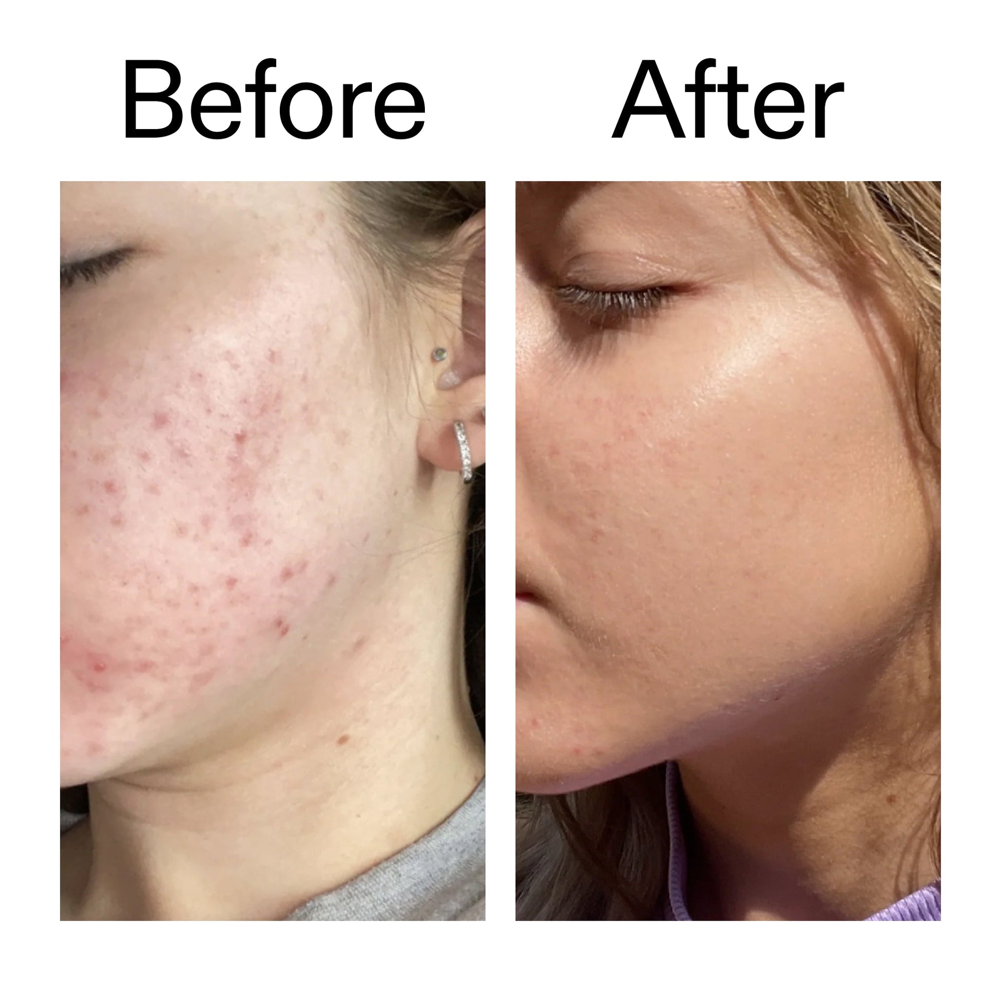 10-niacinamide-serum-duo-j6 Niacinamide_Serum_Before_After_2000x2000_bde32455-9e7d-448e-b053-bef41504f0a9.jpg