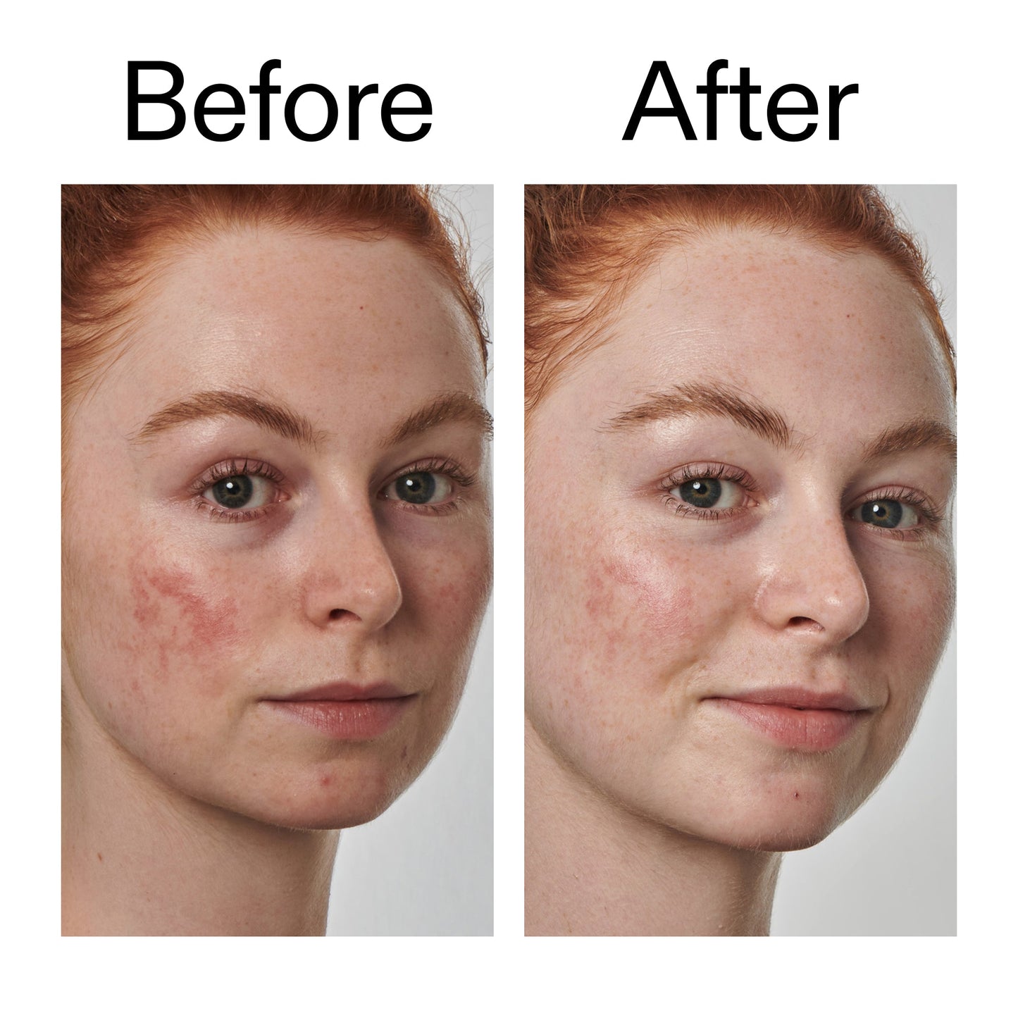 10-azelaic-acid-serum-for-redness-relief-p0 Redness_Relief_Serum_Before_After_2000x2000_3334dc9a-cce9-4e00-8aec-7ad89ca051f2.jpg