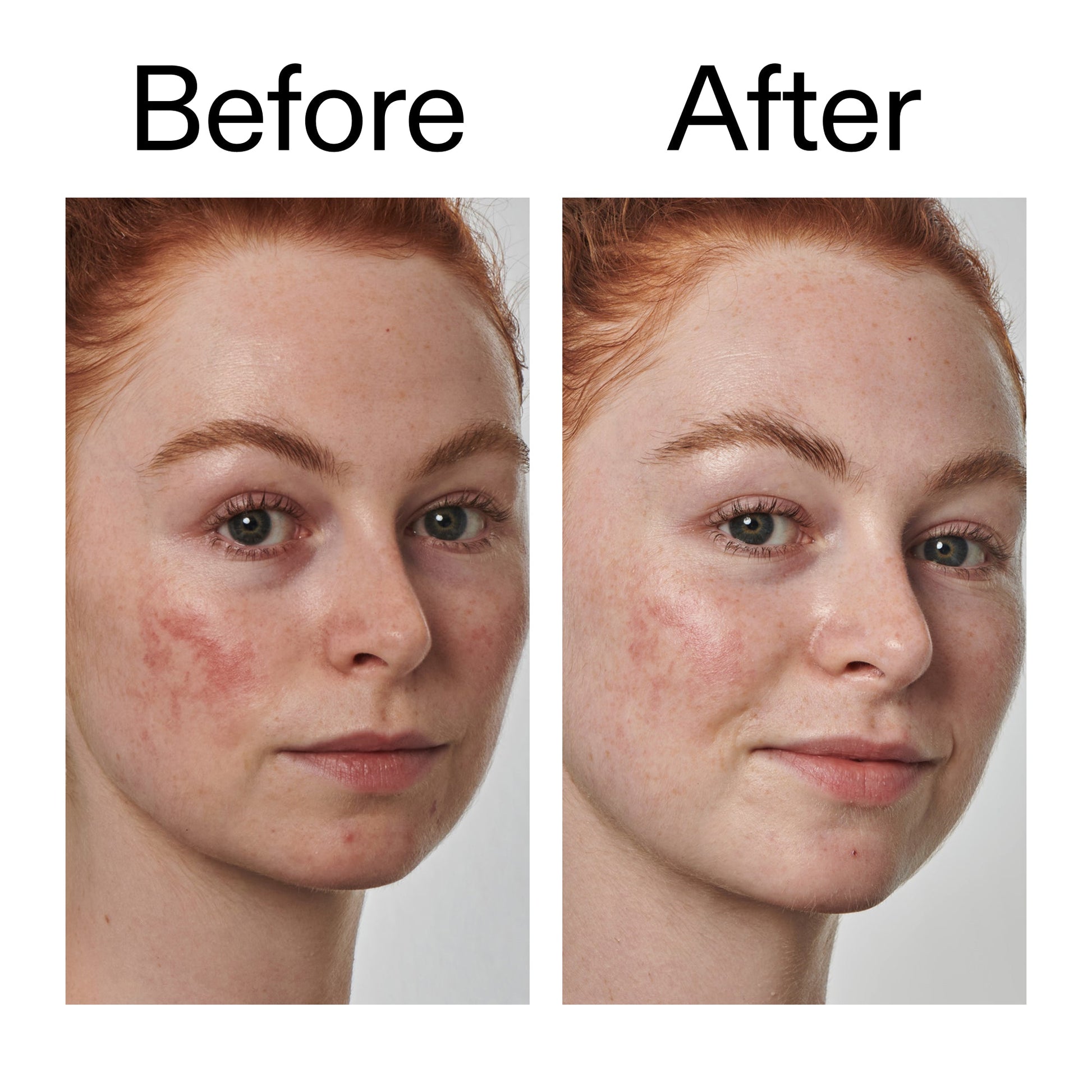 10-azelaic-acid-serum-for-redness-relief-p0 Redness_Relief_Serum_Before_After_2000x2000_3334dc9a-cce9-4e00-8aec-7ad89ca051f2.jpg