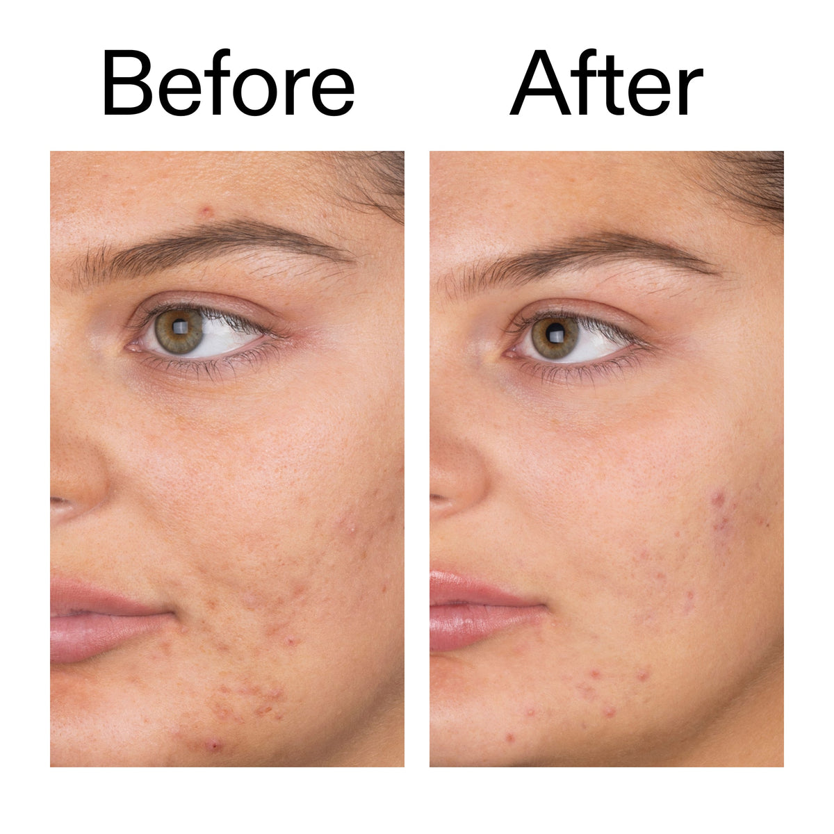 salicylic-acid-cleanser-duo-c8 Salicylic_Acid_Cleanser_-_150ml_Before_After_2000x2000_e7230494-853f-4b07-82b1-27669104c995.jpg