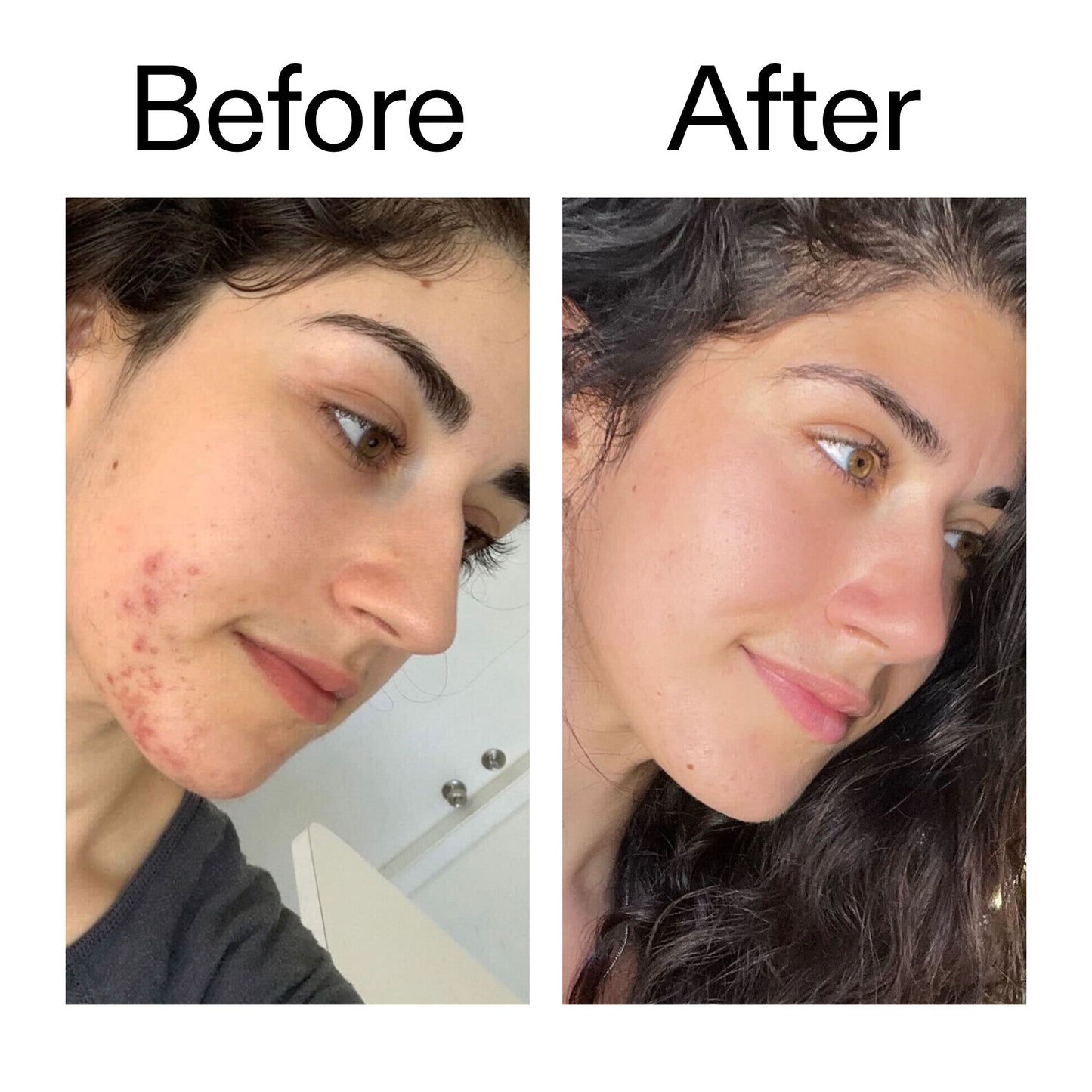 succinic-acid-acne-treatment-g8 Succinic_Acid_Treatment_Before_After_2000x2000_6a5f0054-2f58-4433-9314-0dc72c9bdd3b.jpg