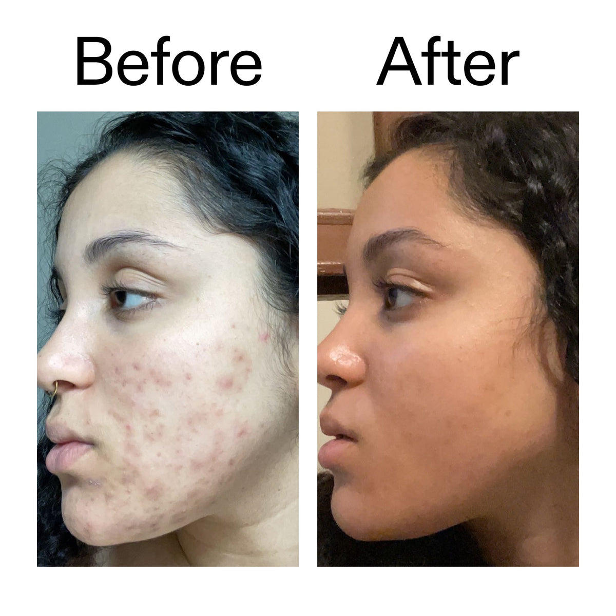 tranexamic-acid-serum-y6 Tranexamic_Acid_Serum_Before_After_2000x2000_98ebc8be-77b0-4843-8a22-90790ebe918b.jpg